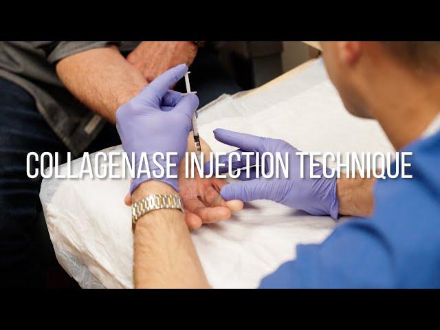 Collagenase Injection Technique for Dupuytren's Contracture