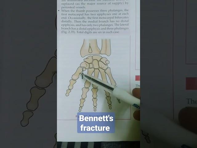 Bennett's fracture