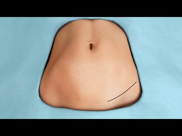 Tummy Tuck Animation