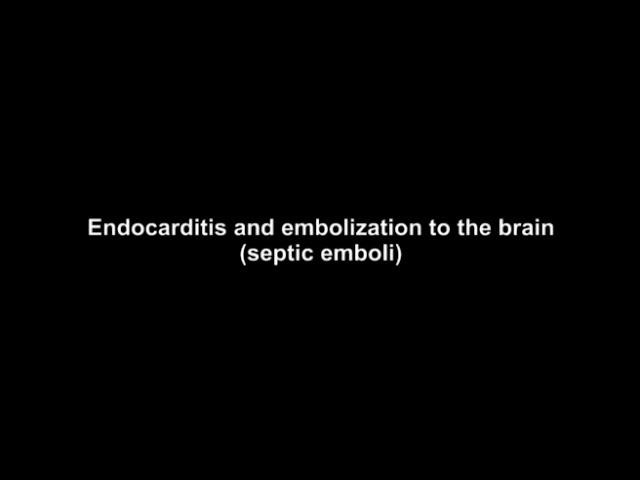 Endocarditis and Stroke - by Cal Shipley, M.D.