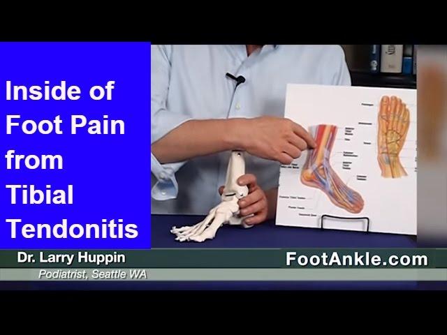 Inside of Foot Pain and Posterior Tibial Tendonitis Treatment – Seattle Foot Doctor