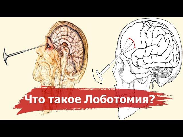 Lobotomy - the nightmare of the 20th century | The history of the most terrible operation