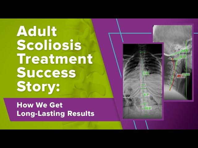 Adult Scoliosis Treatment Success Story: How We Get Long-Lasting Results