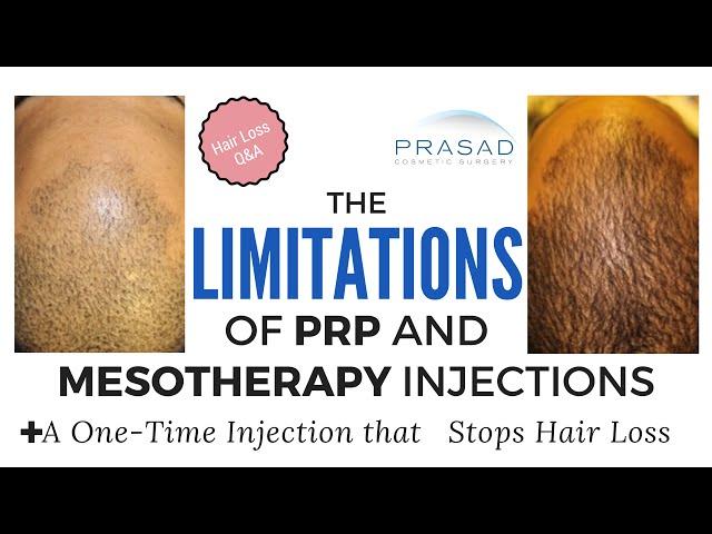 Limitations, Ineffectiveness of PRP, Mesotherapy Hair Loss Treatments, and a Better Alternative