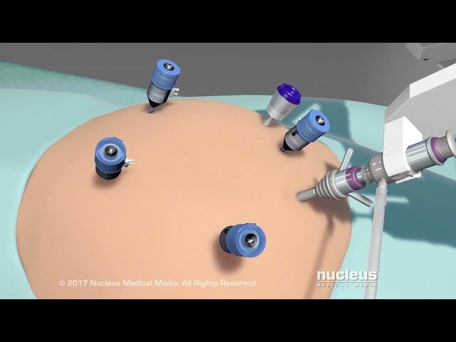 Weight Loss Surgery: Robotic Bariatric Procedure