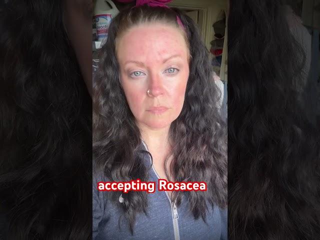 accepting Rosacea (as annoying as it can be sometimes) #rosacea #nofilter #nomakeup