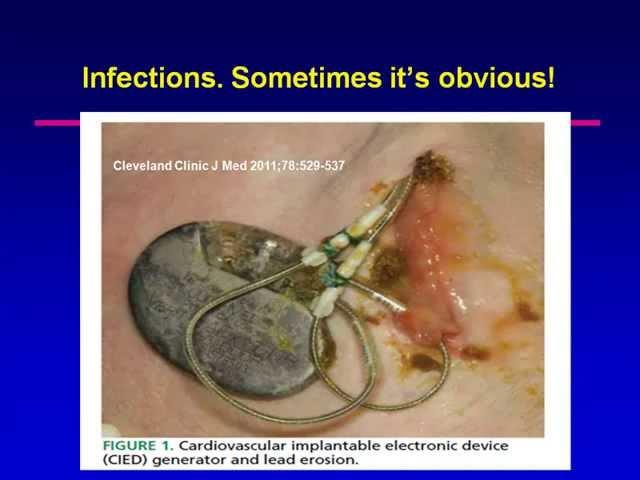 Preventing and Treating Implantable Device Related Infections and Lead Failures - kchrs2011