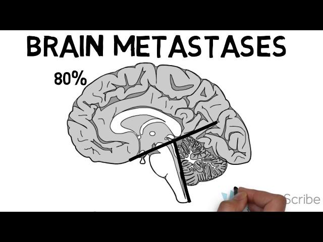 Brain Metastases