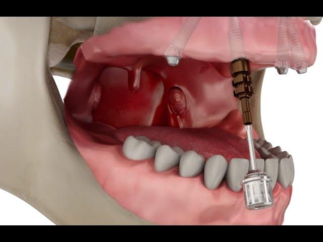 Straumann Pro Arch Step by Step Overview