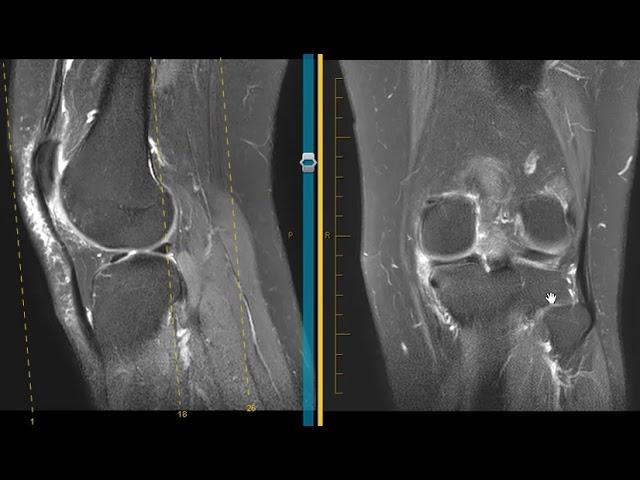 How to diagnose a meniscus tear