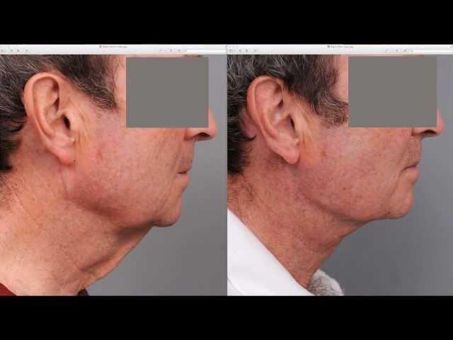 Neck Lift For Men | Dr. Sterry