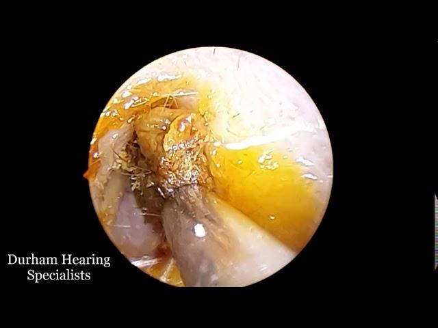 The quickest ear wax removal using microsuction