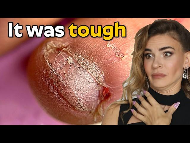 Best Bitten Nails Transformations | Growth & Recovery