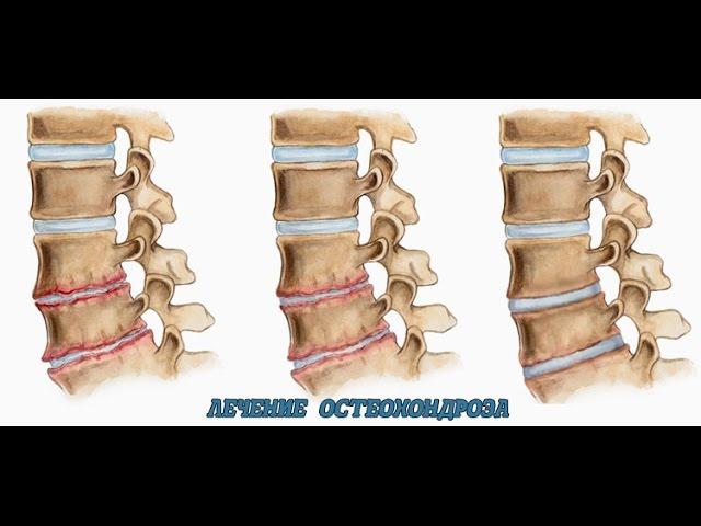 Мексидол при хондрозе