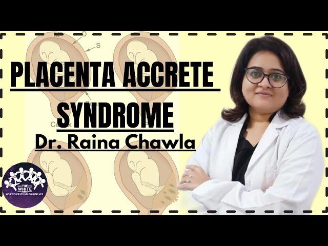 PLACENTA ACCRETE SYNDROME - Concept and MCQs