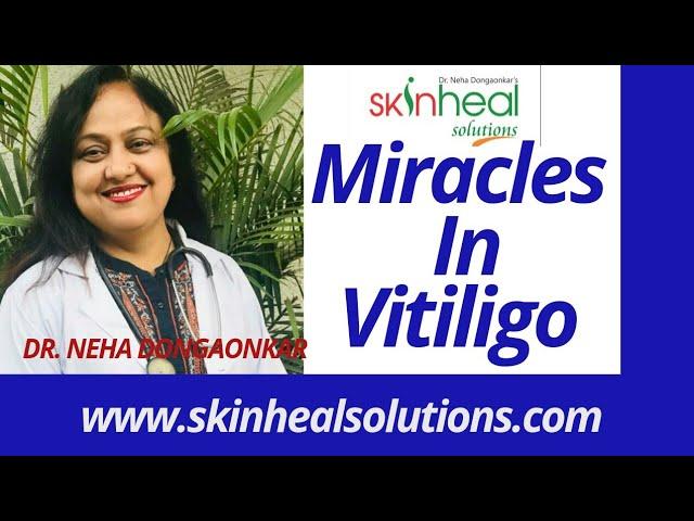 Success story of vitiligo patient