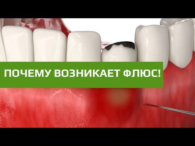 Флюс и абцесс зуба. Как возникает флюс зуба