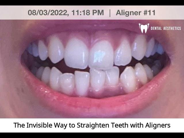 Aligners Journey | Invisible Braces Before And After