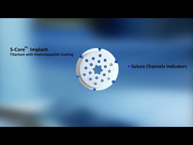 MTP S-Core® Platform Technology | Subchondral Solutions