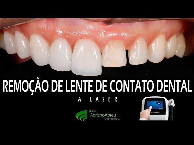 Remoção de lentes de contato dental a laser - (Fortaleza - CE)