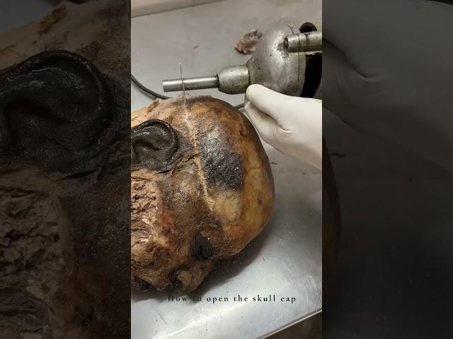 Cadaveric Dissection of skull : For teaching Anatomy