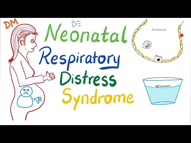 Neonatal Respiratory Distress Syndrome (NRDS) - Pediatrics - Pulmonology