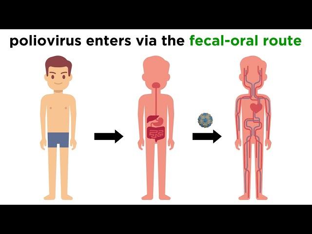 Poliomyelitis (Poliovirus)