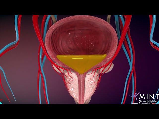 Prostate Artery Embolization (PAE) video