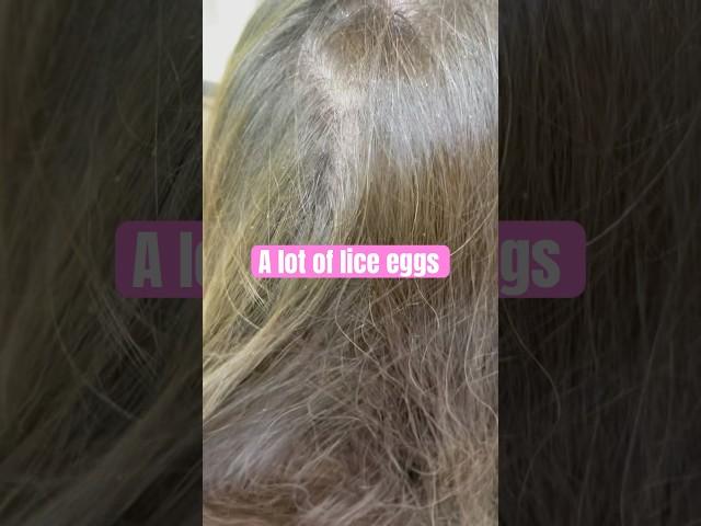 A lot of lice eggs l lice removal service