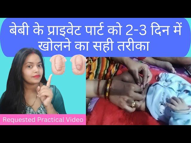 How To Open Baby Boy Private Part within 2-3 Days With Practical Video | बेबी बॉय का सुसु कैसे खोले