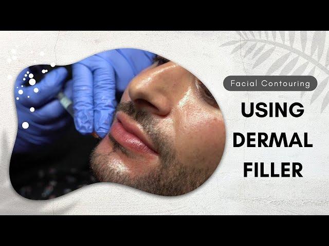 Facial Contouring using Dermal Filler | West Hollywood, CA | Dr. Jason Emer