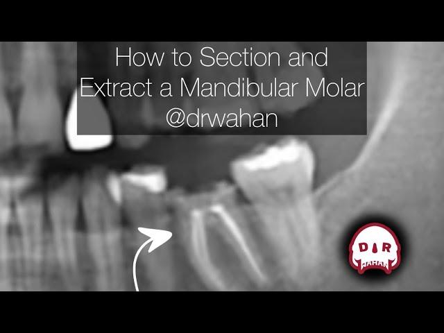 How to Section and Extract a Mandibular Molar @drwahan