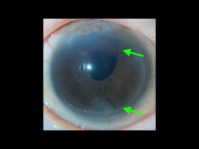 Lens cortex remains in the anterior chamber after cataract surgery