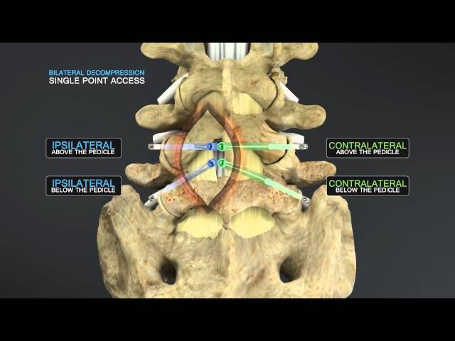 Medical Animation of Lumbar Stenosis Decompression