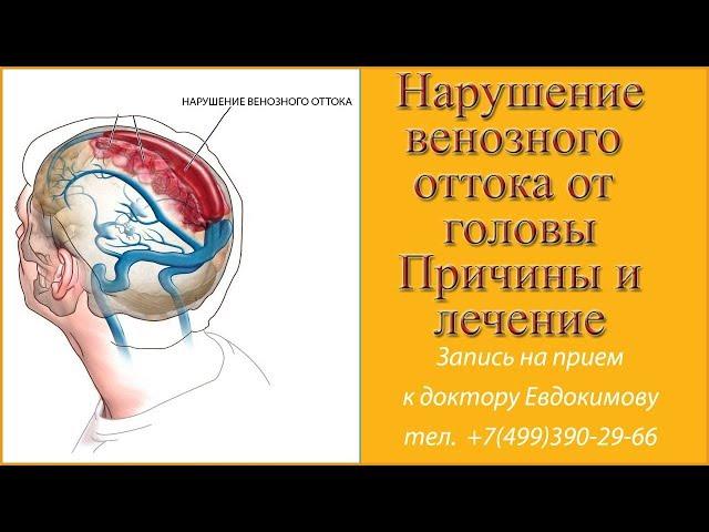 Нарушение венозного оттока головного мозга по позвоночным венам  Причины нарушения венозного оттока