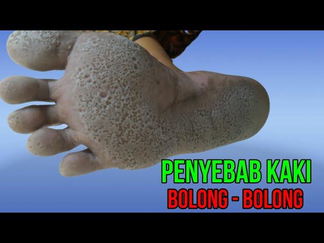 Penyebab Kaki Bolong bolong