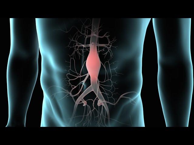 Abdominal Aortic Aneurysm (AAA Repair)