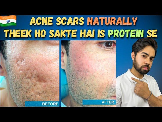 Remove Acne Scars Naturally | 3 Remedies (100% Works) With Results