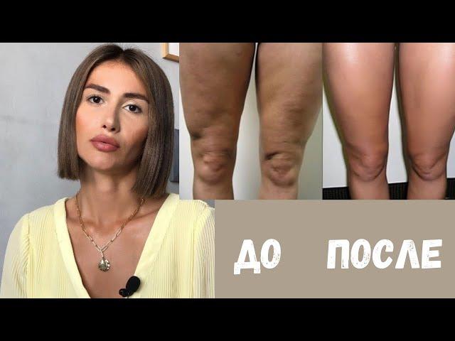 КАК ИЗБАВИТЬСЯ ОТ ЦЕЛЛЮЛИТА? МОЙ ОПЫТ