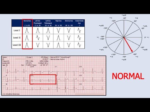 Cardiac Axis Determination