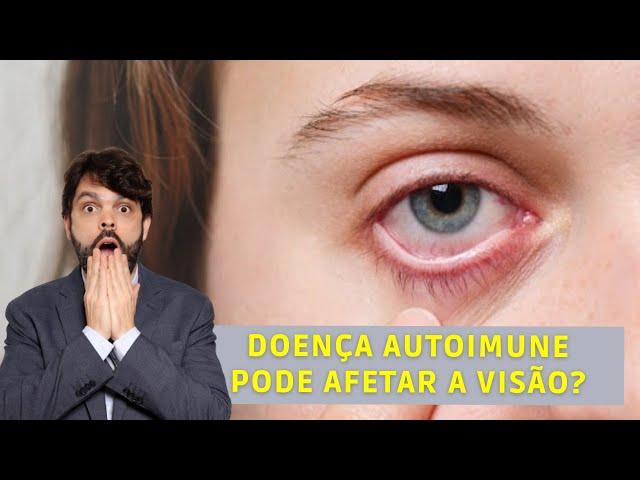 Doença autoimune pode afetar a visão? | Dr. João Paulo Lomelino