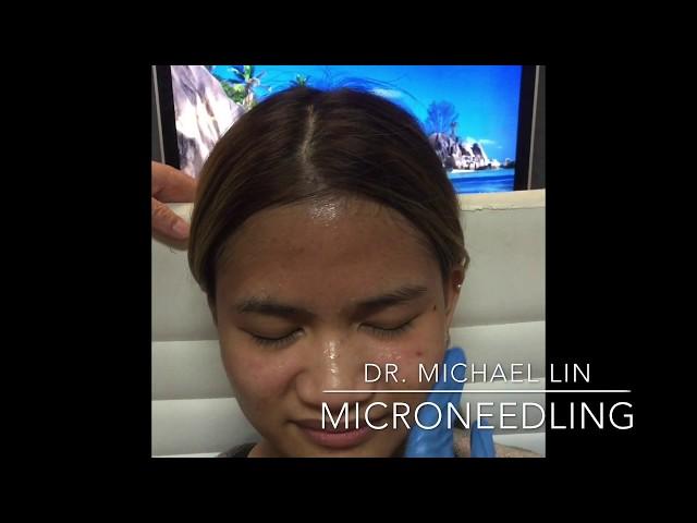 Microneedling with Dr. Michael Lin!