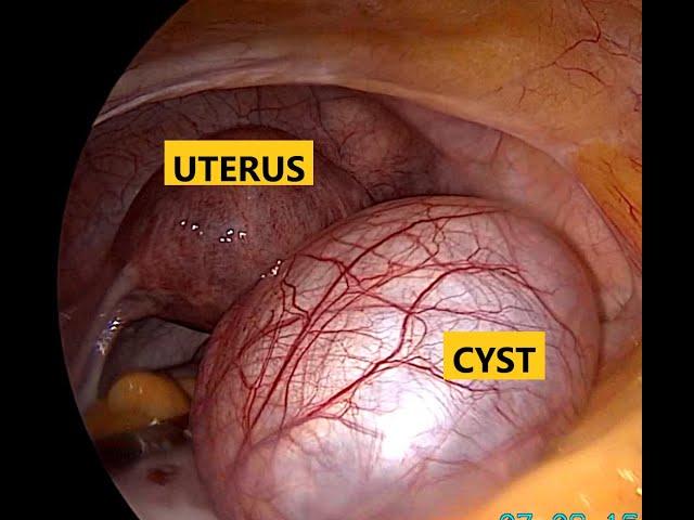 Laparoscopic removal of Para Ovarian Cyst I Dr. Rajeev Agarwal