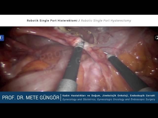 Robotik Single Port Histerektomi / Robotic Single Port Hysterectomy