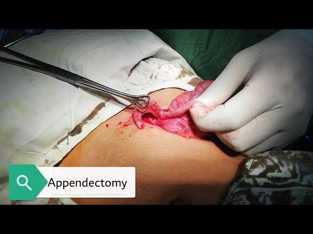 Appendectomy | open surgery | medico mnemonico