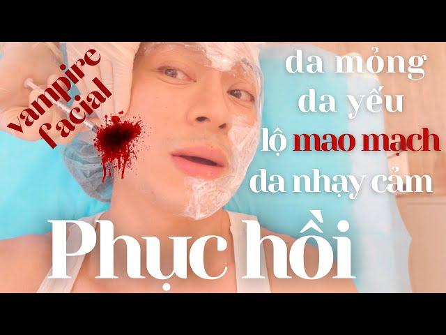 Mình thử nghiệm làm đẹp bằng phương pháp tiêm PRP | Kỳ Kỳ