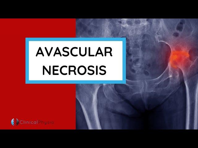 What is Avascular Necrosis (AVN)? | Why does it happen? Who gets it? How do you diagnose it?