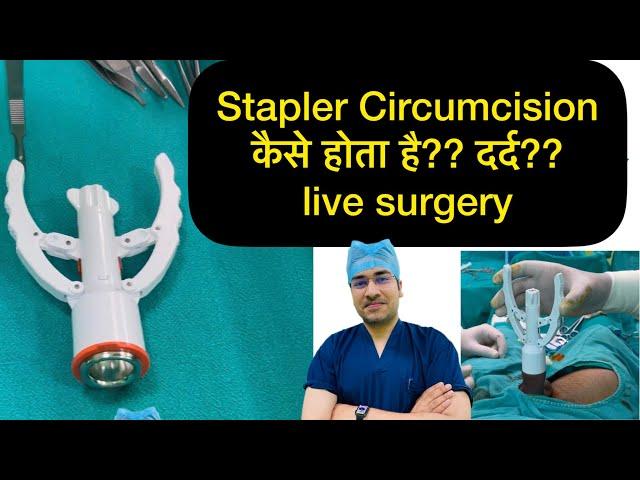 ZSR Circumcision live operation | How stapler circumcision is done | phimosis treatment |