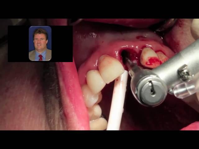 Immediate Dental Implant Surgery  - Dr Scott MacLean Front tooth