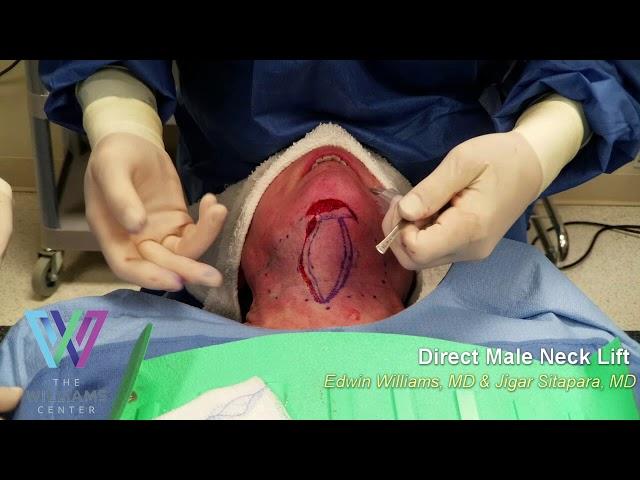 Performing a Direct Male Neck Lift: Dr. Edwin Williams & Dr. Jigar Sitapara